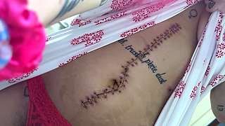 Scar Fetishes Stitches Staples Hospital Recovery After Surgery Teen Petite Small Waist